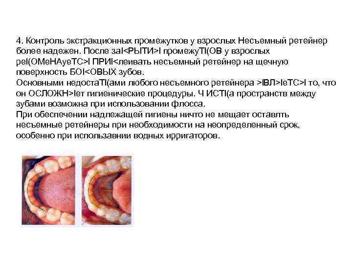 4. Контроль экстракционных промежутков у взрослых Несъемный ретейнер более надежен. После за. I<РЫТИ>l промежу.