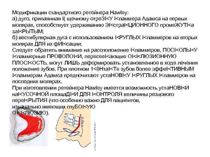 Модификации стандартного ретейнера Hawley: а) дуго, припаянная I( щечному отре. ЗI<У I<ламмера Адамса на