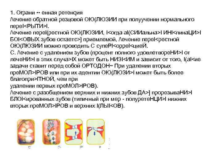 1. Оrрани • • енная ретенqия /ечение обратной резцовой ОЮ(ЛЮЗИИ при полуучении нормального пере.