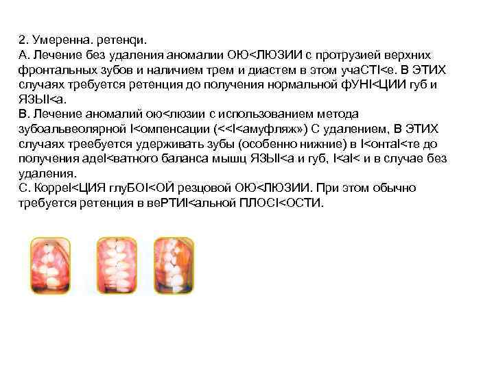 2. Умеренна. ретенqи. А. Лечение без удаления аномалии ОЮ<ЛЮЗИИ с протрузией верхних фронтальных зубов