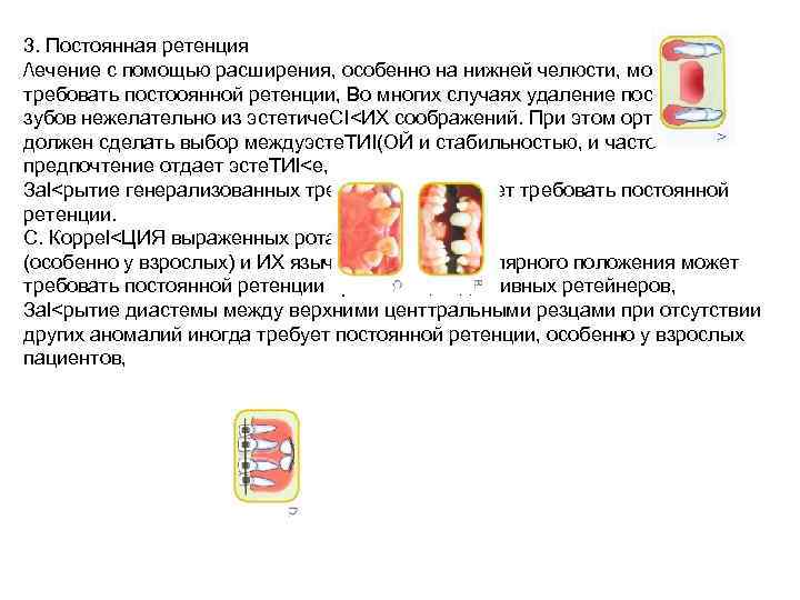 Ретенционные аппараты презентация