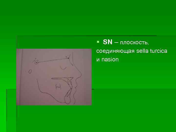 § SN – плоскость, cоединяющая sella turcica и nasion 