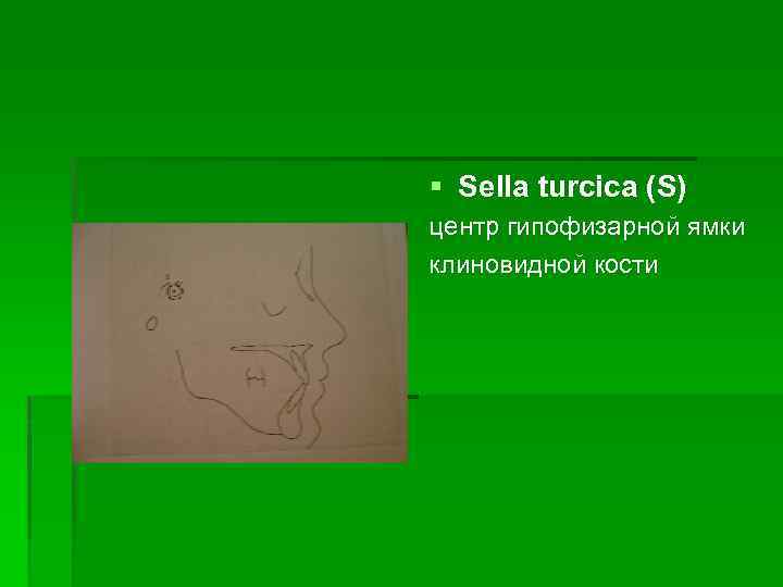 § Sella turcica (S) центр гипофизарной ямки клиновидной кости 