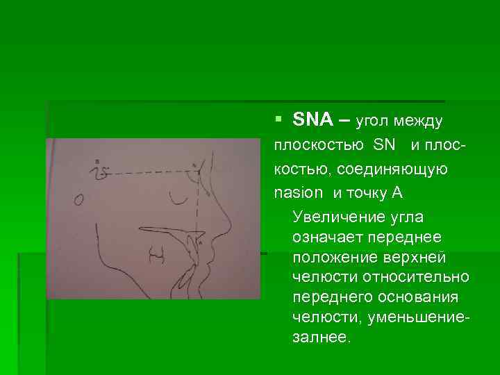 § SNA – угол между плоскостью SN и плоскостью, соединяющую nasion и точку А