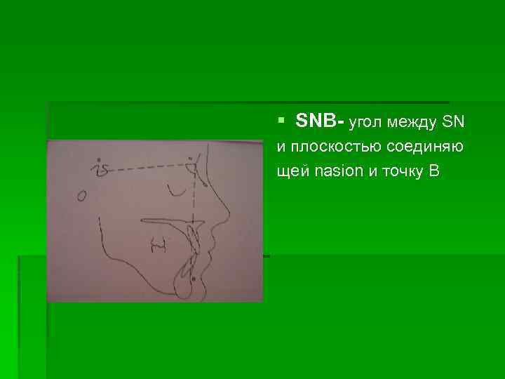 § SNB- угол между SN и плоскостью соединяю щей nasion и точку В 