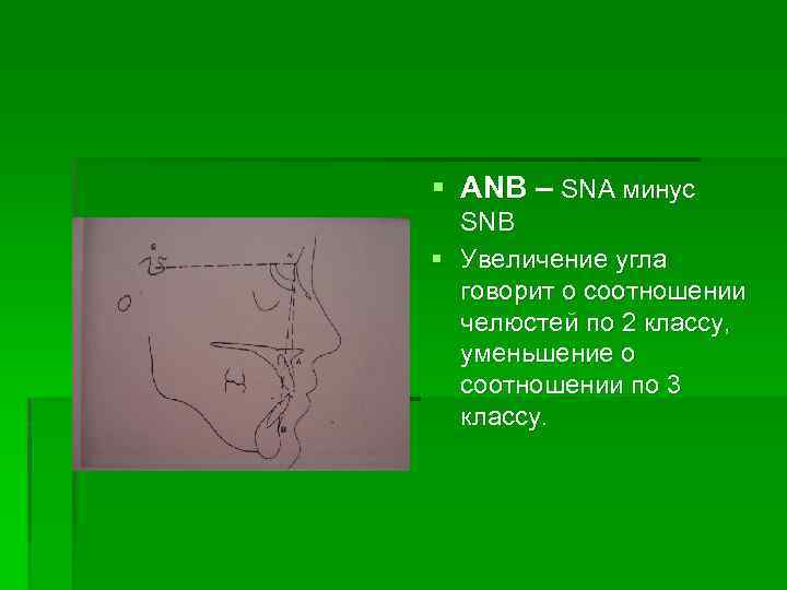 § ANB – SNA минус SNB § Увеличение угла говорит о соотношении челюстей по