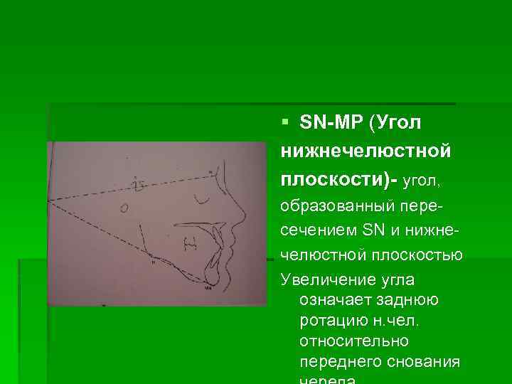 § SN-MP (Угол нижнечелюстной плоскости)- угол, образованный пересечением SN и нижнечелюстной плоскостью Увеличение угла