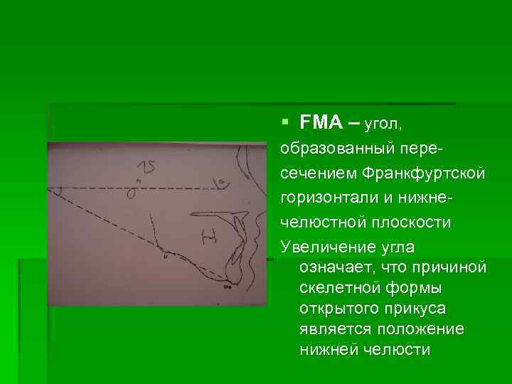 § FMA – угол, образованный пересечением Франкфуртской горизонтали и нижнечелюстной плоскости Увеличение угла означает,
