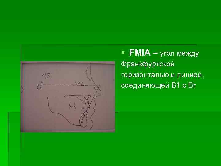 § FMIA – угол между Франкфуртской горизонталью и линией, cоединяющей В 1 с Вr