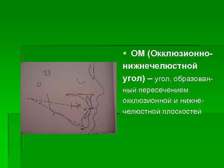 § OM (Окклюзионнонижнечелюстной угол) – угол, образованный пересечением окклюзионной и нижнечелюстной плоскостей 