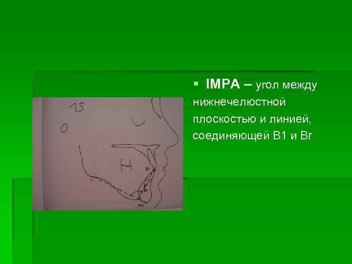 § IMPA – угол между нижнечелюстной плоскостью и линией, соединяющей В 1 и Вr