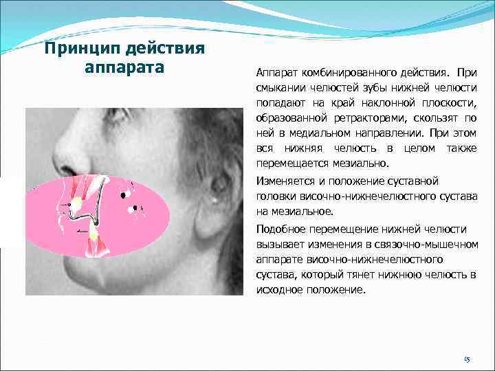 Принцип действия аппарата Аппарат комбинированного действия. При смыкании челюстей зубы нижней челюсти попадают на