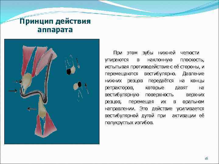 Принцип действия аппарата При этом зубы нижней челюсти упираются в наклонную плоскость, испытывая противодействие