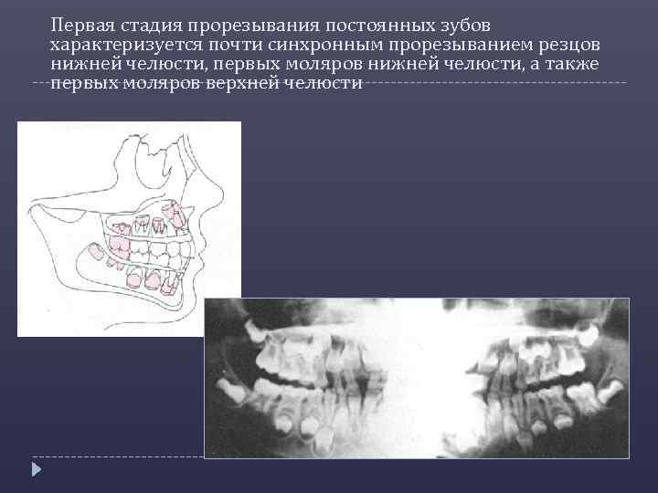 Первая стадия прорезывания постоянных зубов характеризуется почти синхронным прорезыванием резцов нижней челюсти, первых моляров