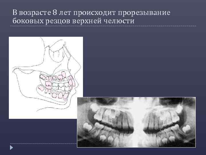 В возрасте 8 лет происходит прорезывание боковых резцов верхней челюсти 