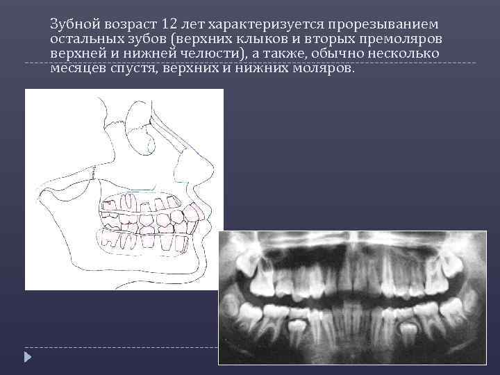 Зубной возраст 12 лет характеризуется прорезыванием остальных зубов (верхних клыков и вторых премоляров верхней