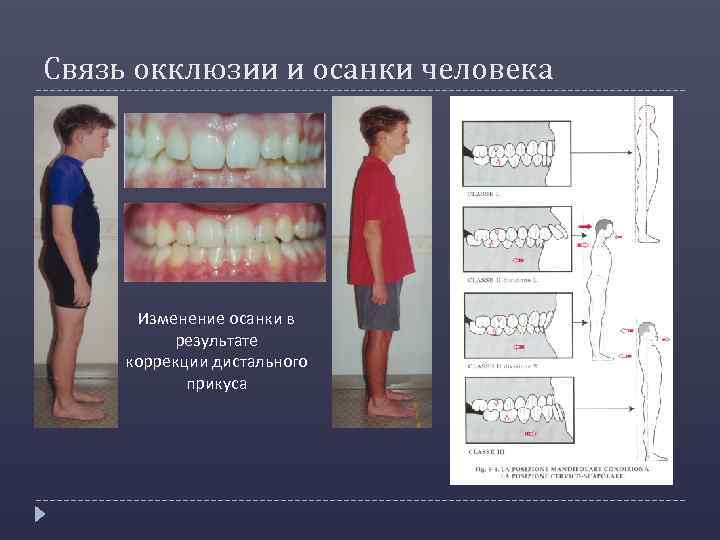 Связь окклюзии и осанки человека Изменение осанки в результате коррекции дистального прикуса 