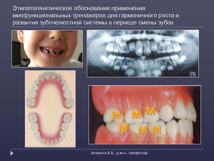 Этипатогенетическое обоснование применения миофункциональных тренажеров для гармоничного роста и развития зубочелюстной системы в периоде