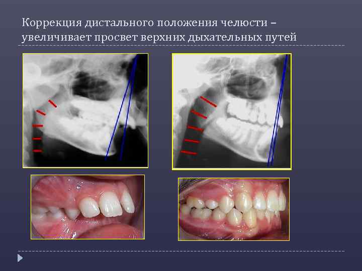 Коррекция дистального положения челюсти – увеличивает просвет верхних дыхательных путей 