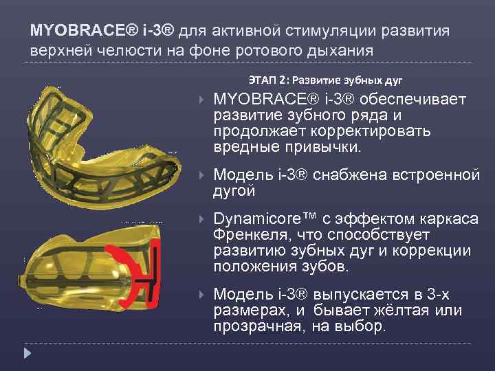 MYOBRACE® i-3® для активной стимуляции развития верхней челюсти на фоне ротового дыхания ЭТАП 2: