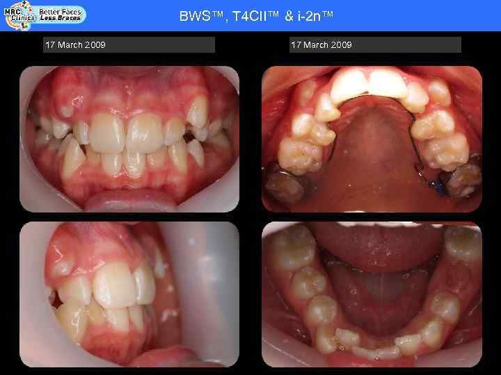 BWS™, T 4 CII™ & i-2 n™ Patient Name: RHYS WADE - COOPER -