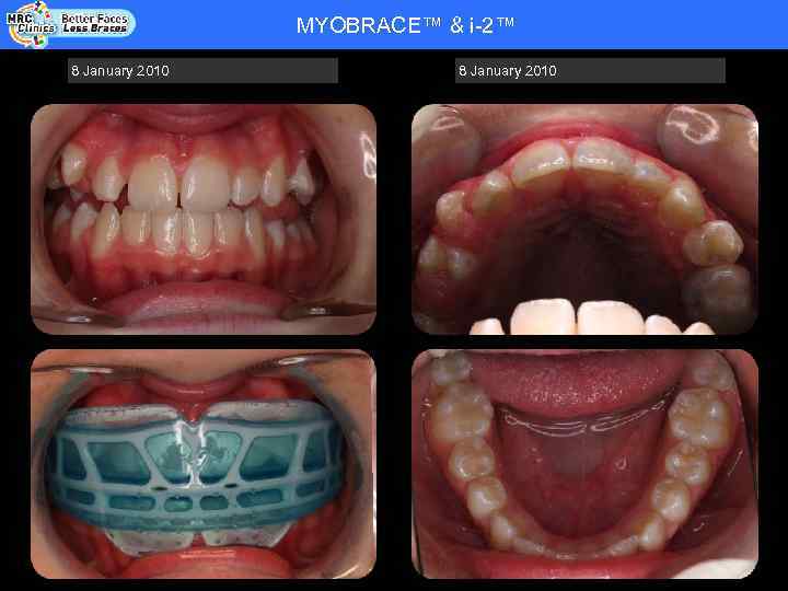 MYOBRACE™ & i-2™ Patient Name: RHYS WADE - COOPER - DOB 20. 08. 92