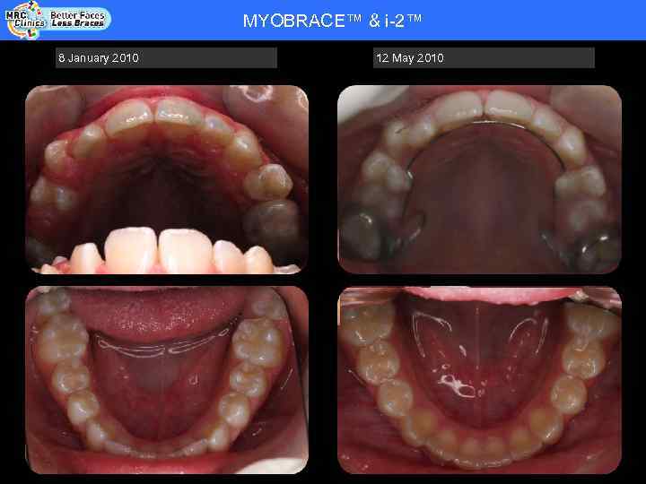 MYOBRACE™ & i-2™ Patient Name: RHYS WADE - COOPER - DOB 20. 08. 92