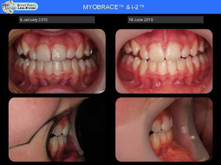 MYOBRACE™ & i-2™ Patient Name: RHYS WADE - COOPER - DOB 20. 08. 92