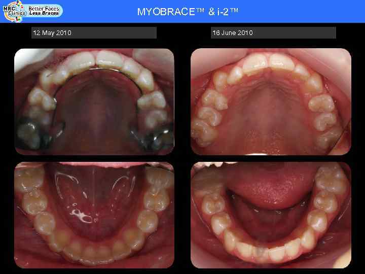 MYOBRACE™ & i-2™ Patient Name: RHYS WADE - COOPER - DOB 20. 08. 92