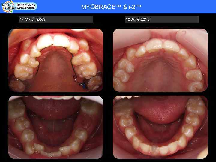 MYOBRACE™ & i-2™ Patient Name: RHYS WADE - COOPER - DOB 20. 08. 92