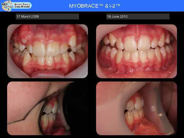 MYOBRACE™ & i-2™ Patient Name: RHYS WADE - COOPER - DOB 20. 08. 92