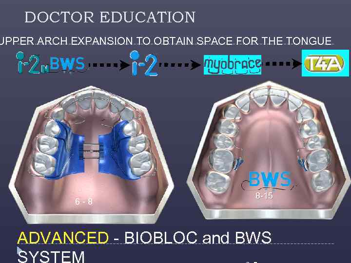 DOCTOR EDUCATION UPPER ARCH EXPANSION TO OBTAIN SPACE FOR THE TONGUE 6 - 8