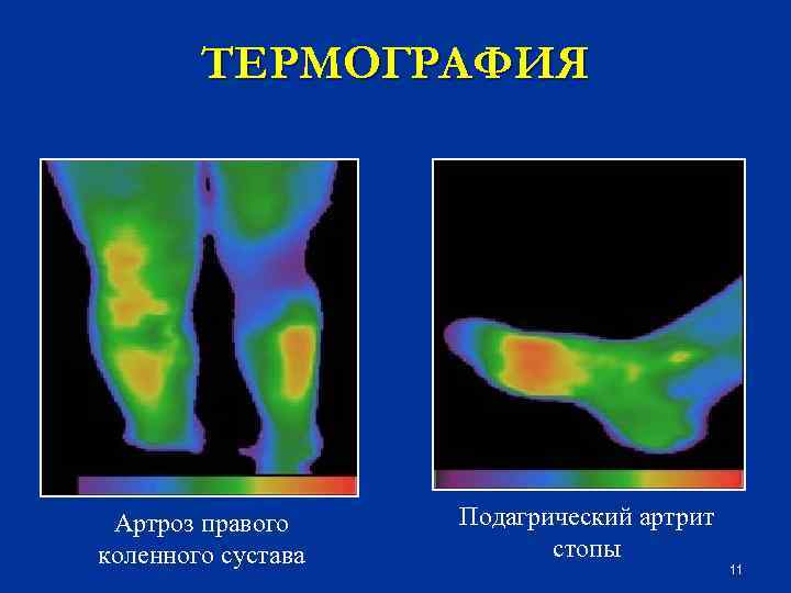 ТЕРМОГРАФИЯ Артроз правого коленного сустава Подагрический артрит стопы 11 