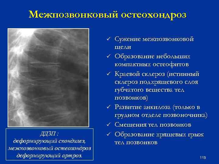 Межпозвонковый остеохондроз ü ü ü ДДЗП : деформирующий спондилез, межпозвонковый остеохондроз деформирующий артроз. ü