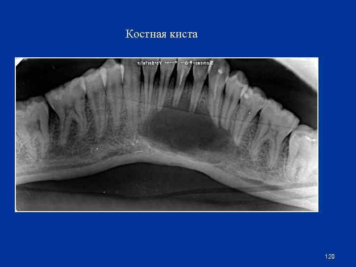 Костная киста 120 