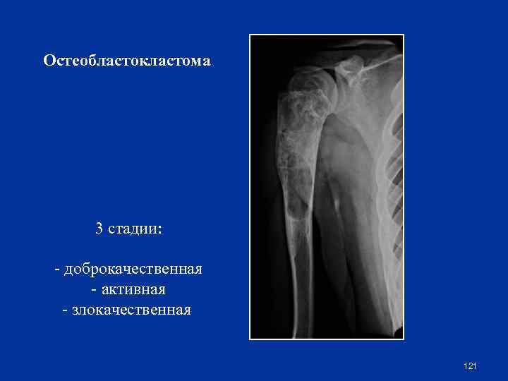 Остеобластокластома 3 стадии: - доброкачественная - активная - злокачественная 121 
