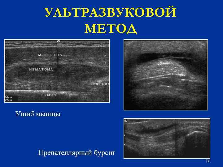 УЛЬТРАЗВУКОВОЙ МЕТОД Ушиб мышцы Препателлярный бурсит 13 