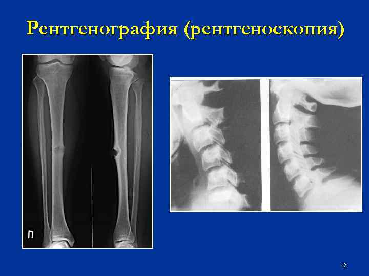 Рентгенография (рентгеноскопия) 16 