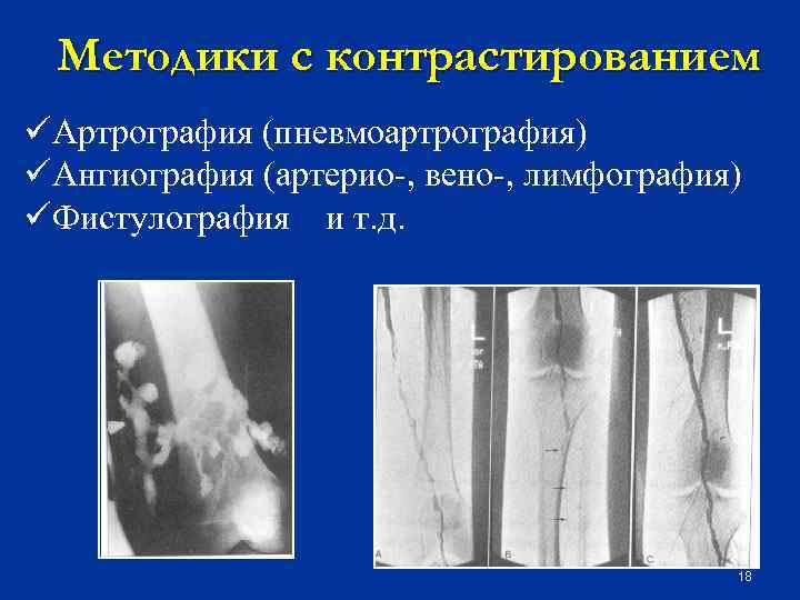 Методики с контрастированием üАртрография (пневмоартрография) üАнгиография (артерио-, вено-, лимфография) üФистулография и т. д. 18