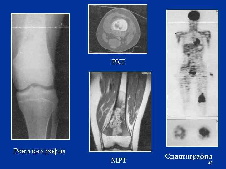 РКТ Рентгенография МРТ Сцинтиграфия 24 