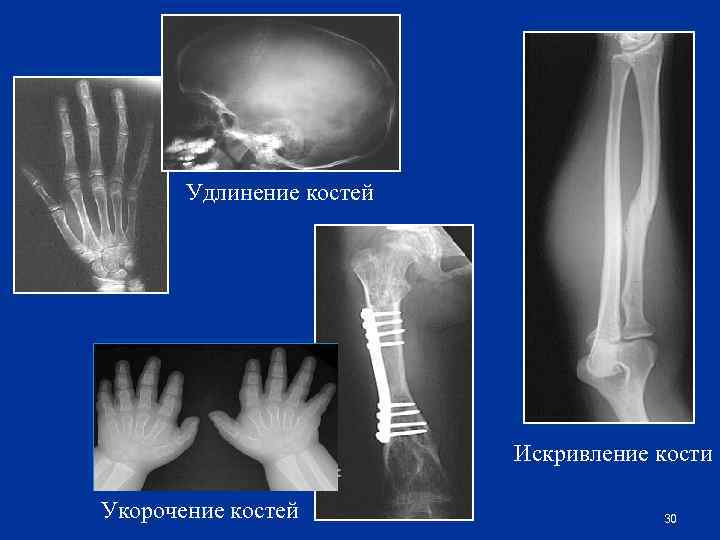 Удлинение костей Искривление кости Укорочение костей 30 