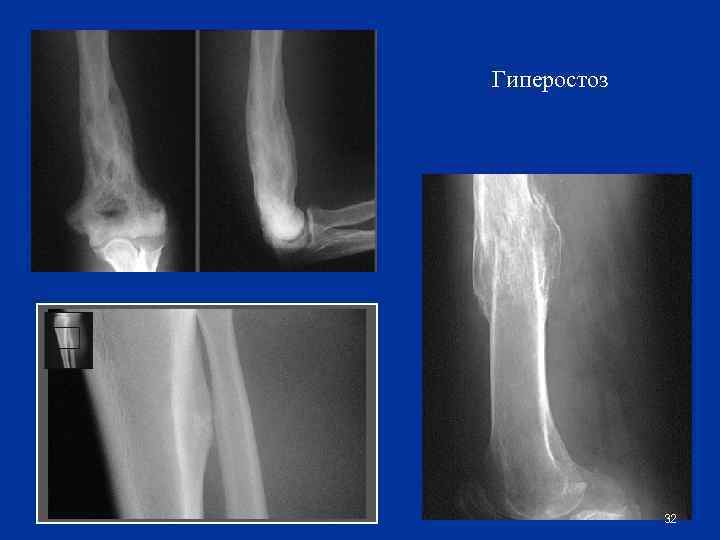 Гиперостоз 32 