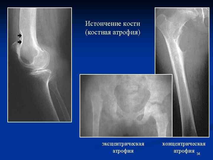 Истончение кости (костная атрофия) эксцентрическая атрофия концентрическая атрофия 34 