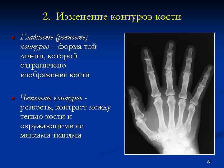 2. Изменение контуров кости Гладкость (ровность) контуров – форма той линии, которой отграничено изображение