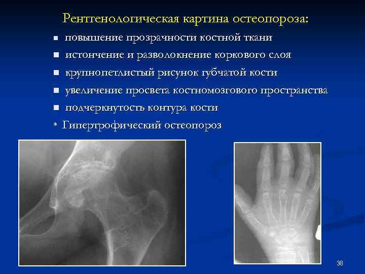 Крупнопетлистый рисунок на рентгене