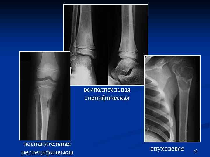 воспалительная специфическая воспалительная неспецифическая опухолевая 42 