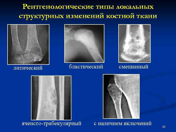 Для рентгенологической картины ячеистой формы гигантоклеточной опухоли характерно