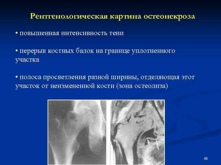 Саркомы костей клинические рекомендации тест нмо. Асептический некроз рентген. Дисбарический остеонекроз. Остеонекроз рентген признаки. Асептический некроз коленного сустава рентген.