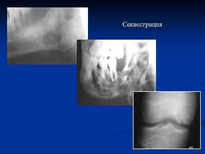 Секвестрация 49 