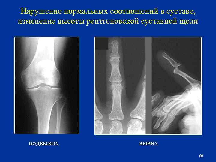 Дистальный метаэпифиз лучевой кости фото